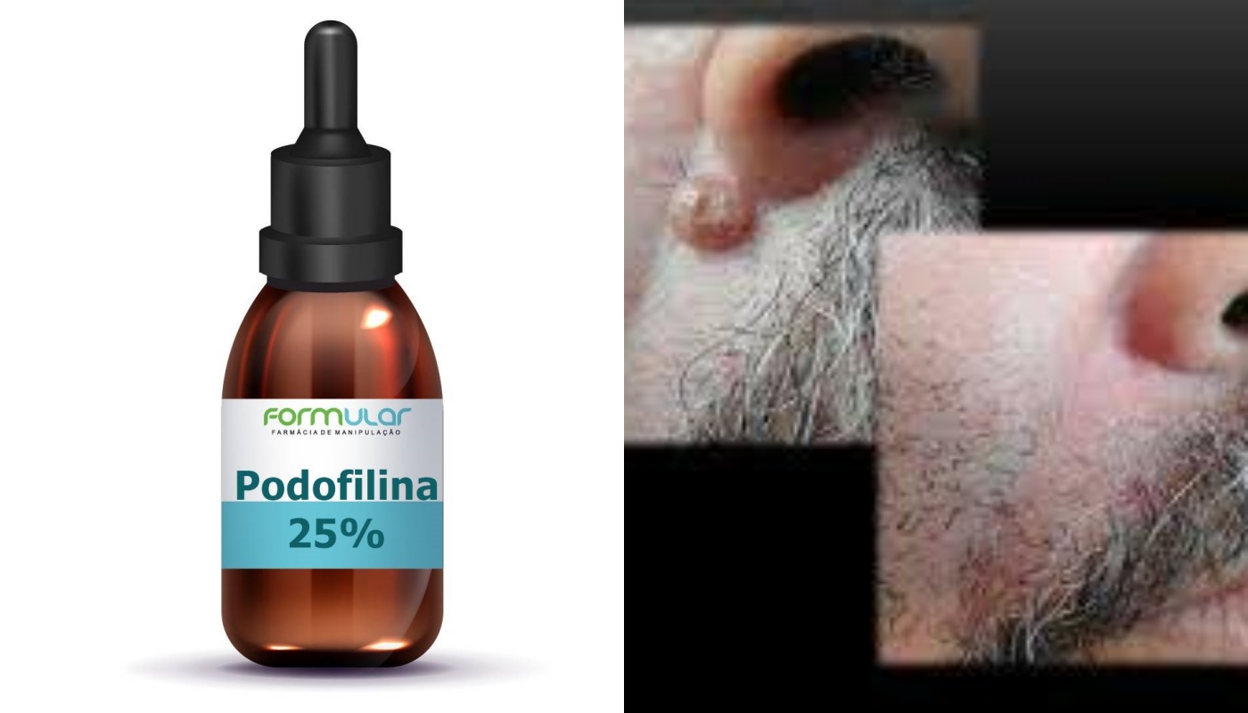 Podofix R  25% -5 ml - Podofilina - Tratamento de Verrugas e HPV