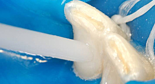 CLAREADOR WHITENESS SUPER ENDO  - Dental Curitibana
