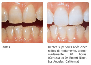 OPALESCENCE CLAREADOR KIT 12 SERINGAS  - Dental Curitibana