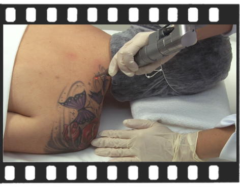 Remoção de Tatuagem - Versão Insta/ Whatsapp  de 1 Minuto.   - Ensinando ao Paciente