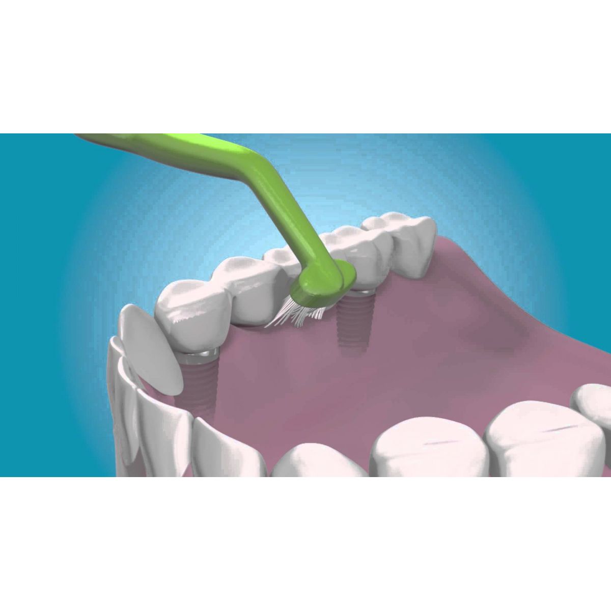 Escova Dental Universal Care | Tepe | Ideal p/ implantes | 1 unidade