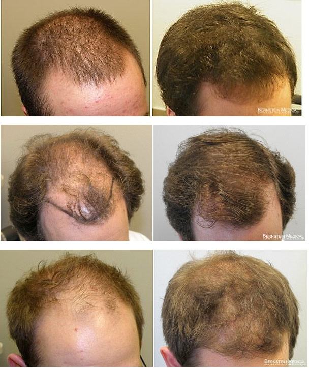 Queda de Cabelo Minoxidil 5% Kirkiland Original - Tratamento para Calvície, Queda e Crescimento, Cabelo e Barba