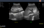 Aparelho de Ultrassom Ecocardiograma - FT422