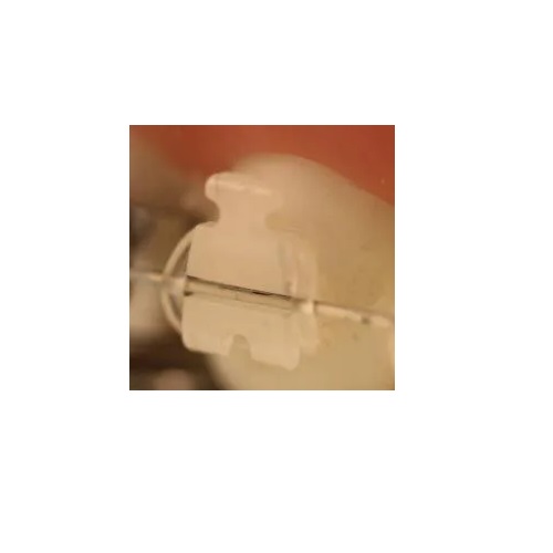 Signature III (Porcelana) MBT - N&F Ortho Dental