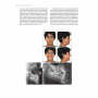 Ortodontia Interceptiva Protocolo De Tratamento Em 2 Fases