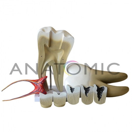 Dente Molar Ampliado 8 Partes com Cárie - ANATOMIC TGD-0311-G
