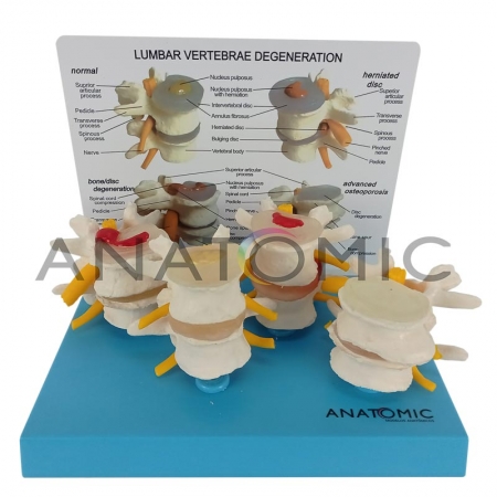 Vértebras Demonstração da Degeneração em 4 fases - ANATOMIC TGD-0155-A